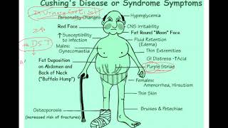 Cushing syndrome Dexamethasone suppression test explained [upl. by Roselba]