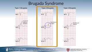 Brugada Syndrome by G Dhillon  OPENPediatrics [upl. by Aciria]