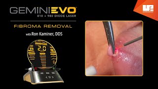 Fibroma Removal  Gemini EVO™ clinical cases [upl. by Ekard]