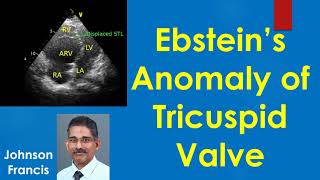 Ebsteins Anomaly of Tricuspid Valve [upl. by Llewoh]