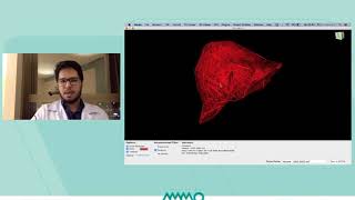 HEPATIMETRIA COMO CALCULAR A VOLUMETRIA HEPATICA [upl. by Newcomer]