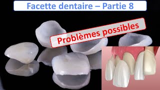 Facette dentaire  Problèmes possibles  Guide complet  partie 8 [upl. by Ebbarta819]