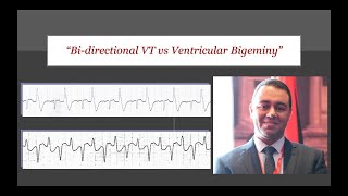 ECG Tip 24 BDVT vs VB [upl. by Einnoj223]