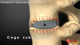 Bioflex Functional Cage SystemBiospine [upl. by Banky460]