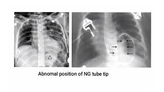 Diaphragmatic Rupture amp CXR  Sign  Radiology [upl. by Aeslahc151]