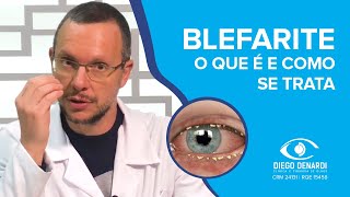 BLEFARITE A inflamação das pálpebras  Dr Diego Denardi  2020 [upl. by Blaise675]