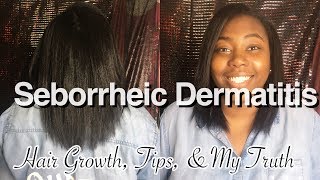 Seborrheic Dermatitis  Hair Growth  Tips amp My Story [upl. by Nnateragram]