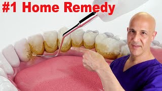 1 Home Remedy to Remove Dental Plaque amp Tarter to Prevent Cavities  Dr Mandell [upl. by Giles]