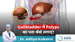 Gallbladder में Polyps का पता कैसे लगाएं  Dr Aditya Kulkari [upl. by Ferneau]