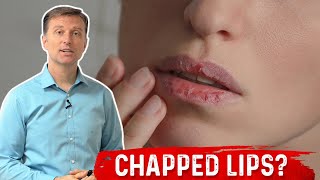 Which Vitamin Deficiency Causes Chapped  Cracked Lips – Dr Berg [upl. by Triley172]