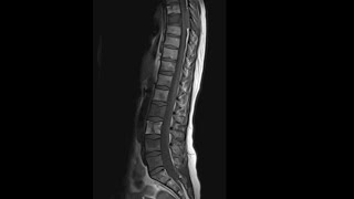 Case of the week 17 Lymphoma causing compressive myelopathy and bony involvement [upl. by Hourigan]