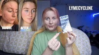 my acne journey  lymecycline [upl. by Avehs677]