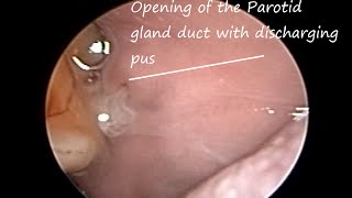 Disorder of Salivary Gland  Pus discharge from parotid duct opening Acute Suppurative Parotitis [upl. by Ner415]