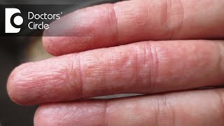 Difference between atopic dermatitis and eczema  Dr Rashmi Ravindra [upl. by Boj]