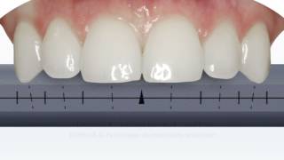 OptraSculpt Pad  Echelles [upl. by Laws]