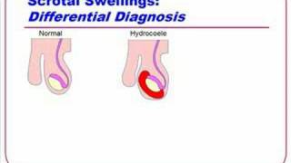 Introduction to Clinical Surgery Lectures  05 Scrotal Swellings [upl. by Aeet]