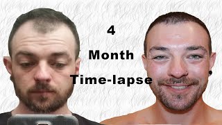 Hair Transplant Timelapse 04 months [upl. by Pinckney]