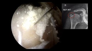 EPAULE N°3  Calcification [upl. by Yremrej]