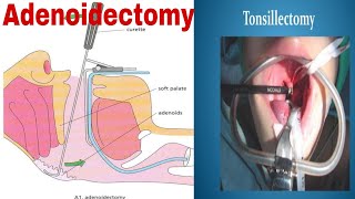 Tonsillectomy  Adenoidectomy ENT Completed🥳 [upl. by Ermey]