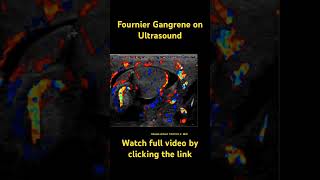 Fournier gangrene radiology radiologyresident medicine ultrasound dermatology [upl. by Jozef]