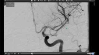 How Endovascular Stroke Treatment Works [upl. by Boleslaw766]