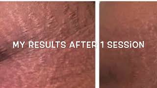 Microneedling Stretch Marks Treatment Before and After [upl. by Lerrud]