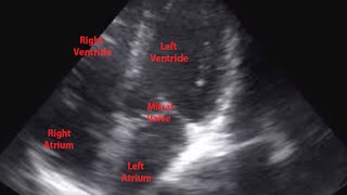 Echocardiogram of Premature Ventricular Contraction  Loop [upl. by Claude908]