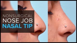 Nonsurgical Nose Job in San Francisco Fillers for the Nasal Tip [upl. by Sivatco409]