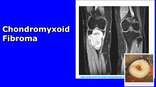 Chondromyxoid fibroma  A short summary of a strange benign tumor [upl. by Sucramel430]