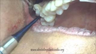 Buccally placed supernumerary molar tooth removal using elevator [upl. by Ozan704]