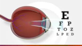 What is myopia  3D animation of myopia [upl. by Albur]