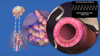 Pathology of Pulmonary Hypertension and Right Heart Failure [upl. by Asher]