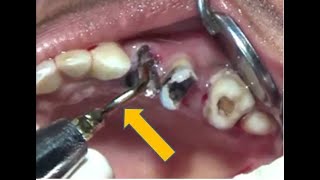 Piezo assisted grossly decayed maxillary teeth removal [upl. by Gavini113]