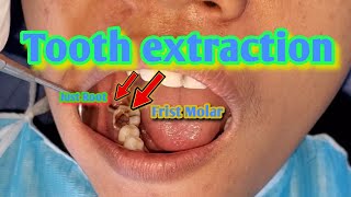 Tooth extraction  1 Molar and just root  TEETH SMILE RESTORATION [upl. by Trueblood]