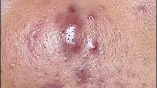 CloseUp Blackhead Removal Watch Every Pore Get Cleansed [upl. by Anileva437]