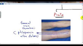 GENERAL PATHOLOGY 40  hyperaemia and oedema DR SAMEH GHAZY [upl. by Tamiko436]