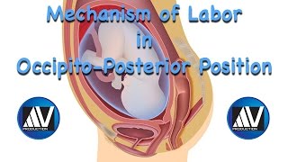 Mechanism of Labor in OccipitoPosterior Position [upl. by Ettedranreb]