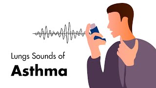 Sounds of Asthma  Wheezing Lung Sounds [upl. by Awuhsoj315]