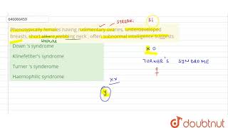 Phenotypically females having rudimentary ovaries underdeveloped breasts short stture webbing [upl. by Enael]