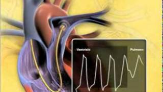 Swan Ganz Physiology [upl. by Anilag]