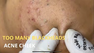 Blackheads amp Whiteheads Removal New 2024 Acne Treatment With Nhat Bang [upl. by Fionnula]