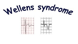 Wellens syndrome [upl. by Nomihs692]