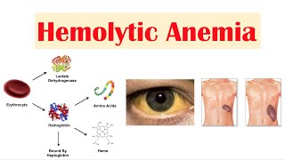 Hemolytic Anemia [upl. by Ordnazil441]