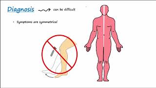 GuillainBarre Syndrome GBS Described Concisely [upl. by Tybald]