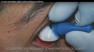 Prótesis Oculares en México  Clínica Iglesias [upl. by Ahsat]