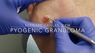 Pyogenic Granuloma [upl. by Cherye]