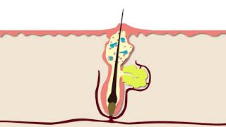 How Acne Develops  Acne Support [upl. by Krasnoff801]