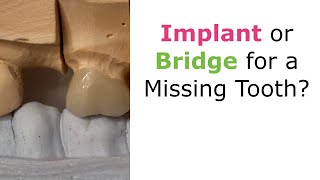 Implant or Bridge for a Missing Tooth [upl. by Selmner]