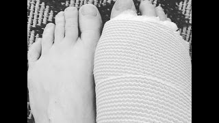 Bunion Surgery Part 2  Surgery amp First Week of Recovery [upl. by Ardnaet]