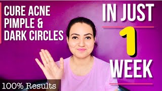 Acne Treatment  All You Need To Know About Acne And Pimple  Best Home Remedy for Acne amp Pimple 💕💕 [upl. by Whitnell]